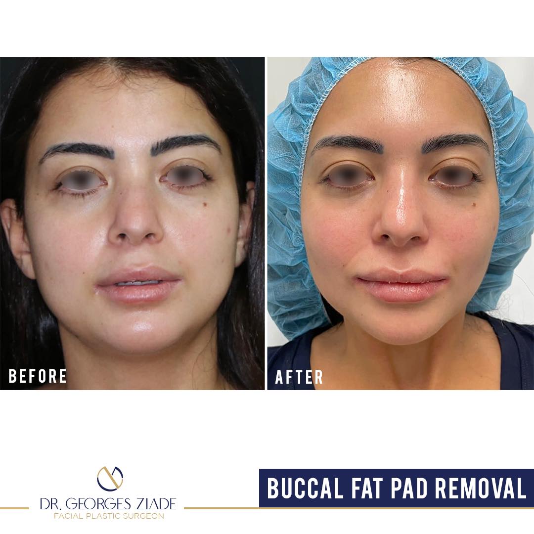 Bichectomy or buccal fat removal Dr. Ziade Clinics